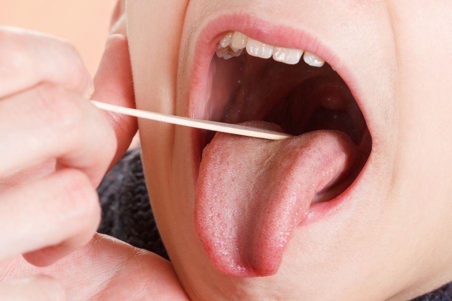 سرطان دهان علل، علائم و درمان