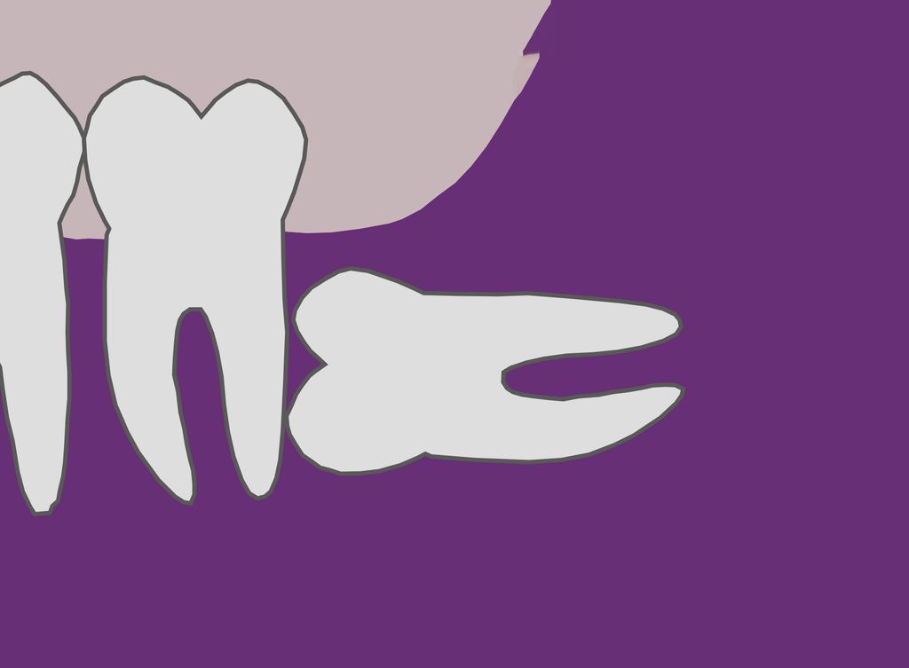 رشد دندان عقل به صورت افقی