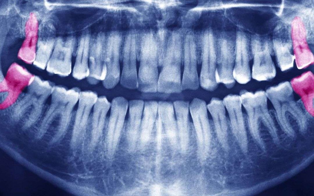 دندان عقل چیست؟