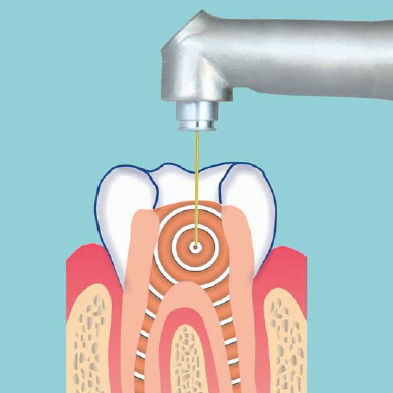 درمان ریشه دندان با لیزر