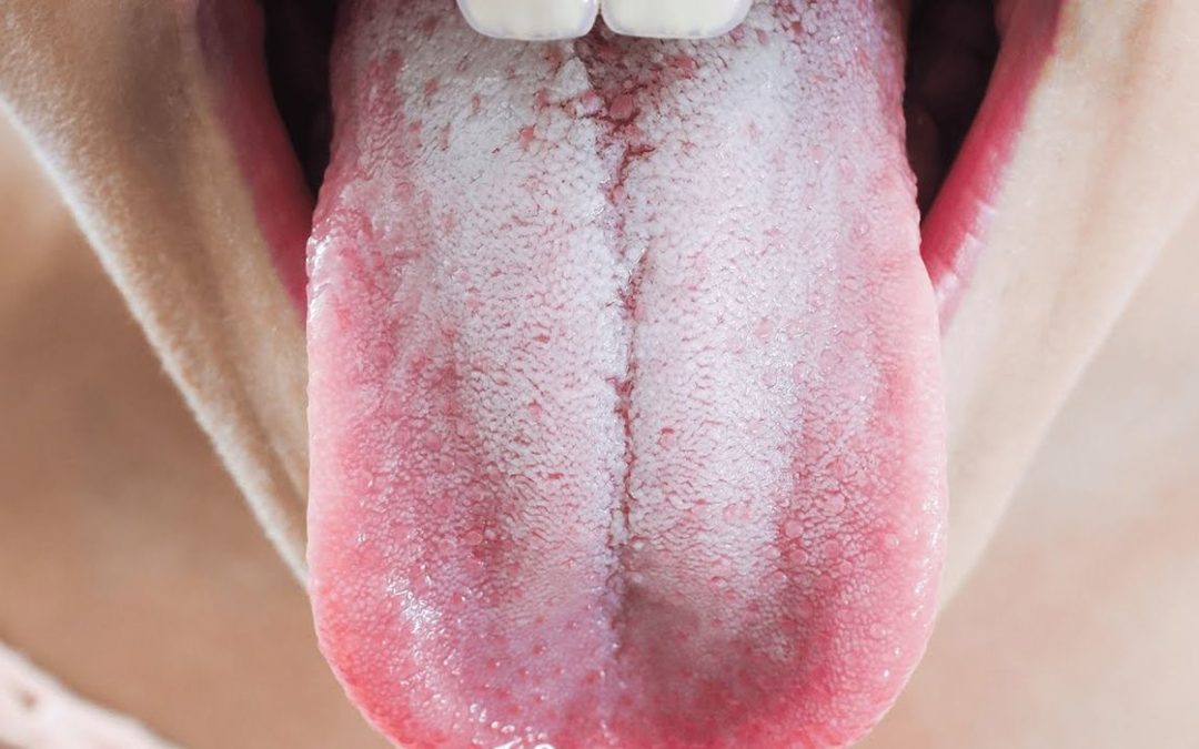 برفک دهانی(عفونت دهان)چیست؟