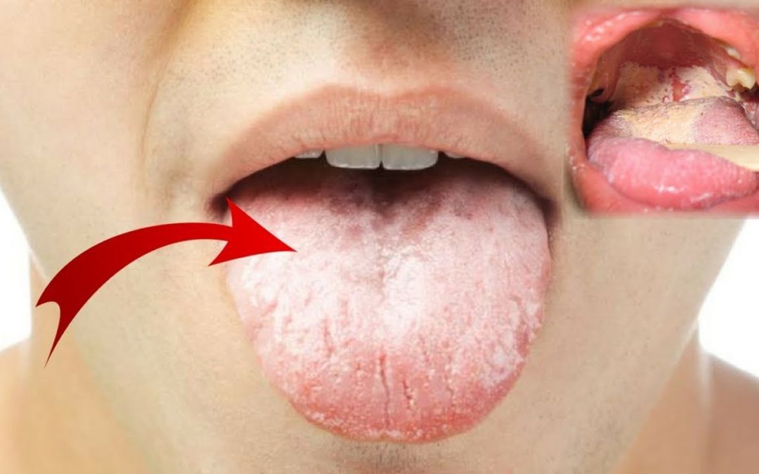 درمان برفک دهان چگونه است؟