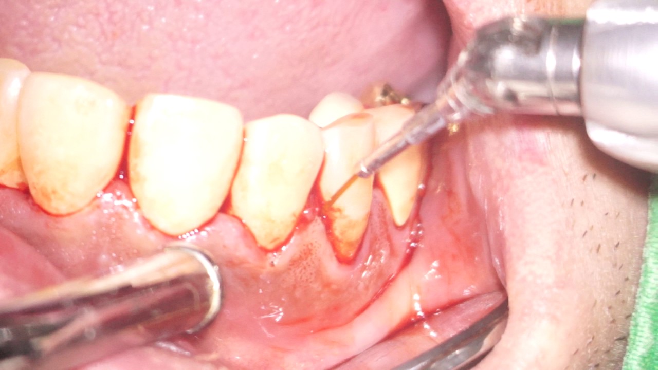 کورتاژ لثه