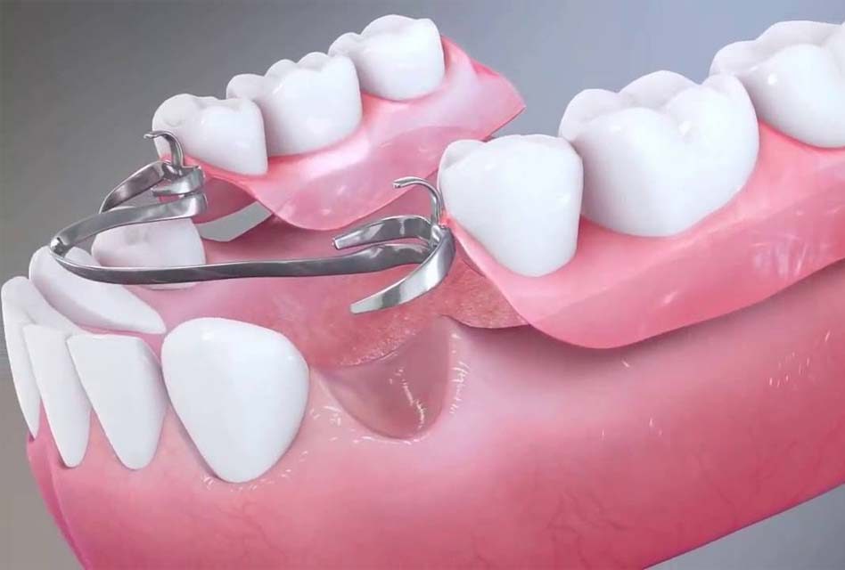 پروتزهای متحرک پارسیل