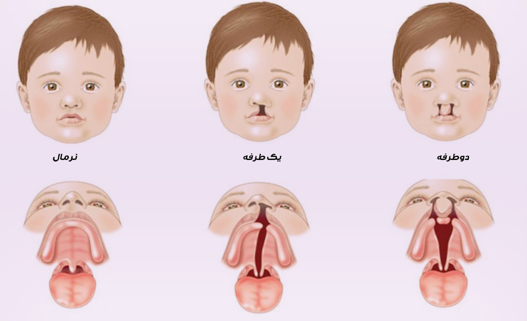 شکاف لب و کام چیست؟
